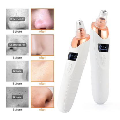 Electric Blackhead Remover - Vacuum Suction Cleaner