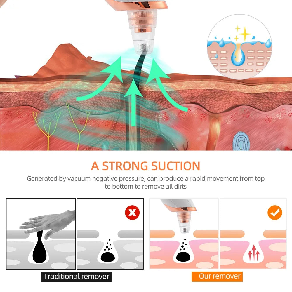 Electric Blackhead Remover - Vacuum Suction Cleaner