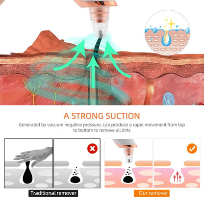 Electric Blackhead Remover - Vacuum Suction Cleaner